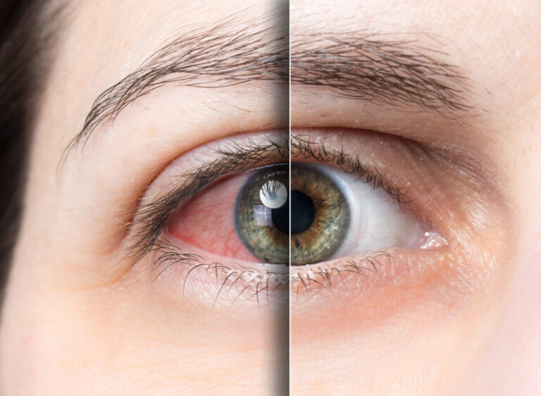 image of a red eye before and after treatment